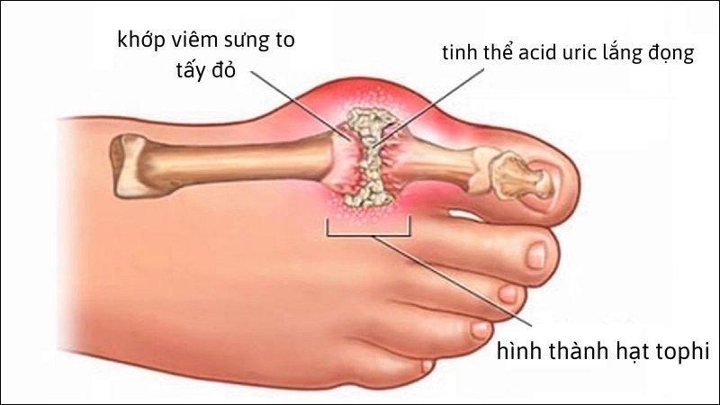 Bệnh Gout: Nguyên nhân, triệu chứng và cách điều trị