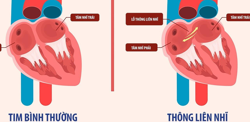 Chi phí phẫu thuật tim thông liên nhĩ là bao nhiêu?