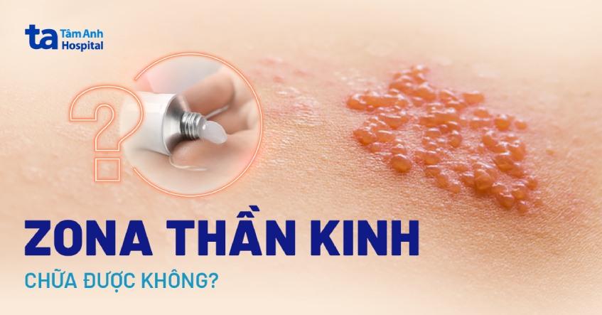 cách chữa zona thần kinh