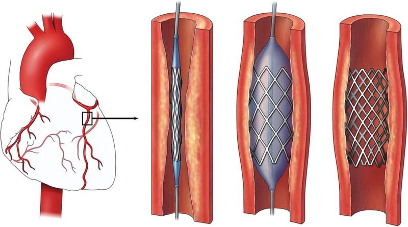 Chi phí đặt stent mạch vành có mắc không? 2