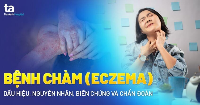 Bệnh chàm (Eczema): Dấu hiệu, nguyên nhân, biến chứng và chẩn đoán