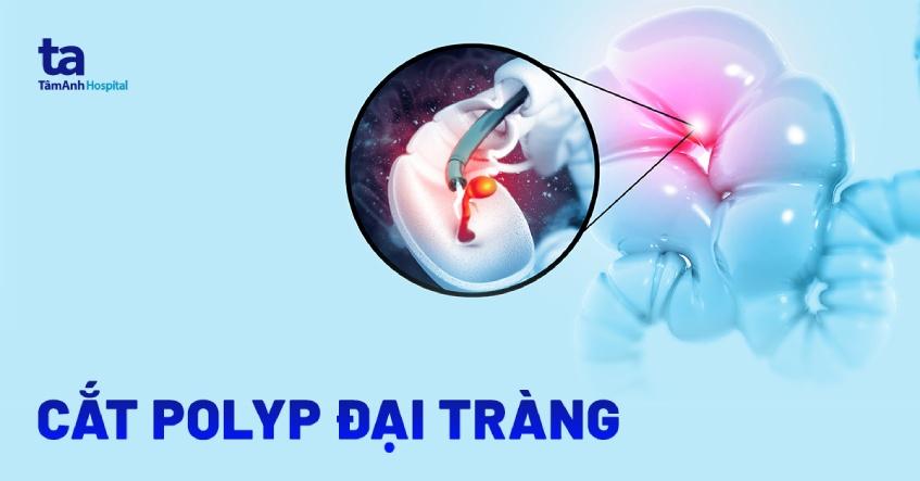 Cắt polyp đại tràng: Quy trình và khi nào cần thực hiện kỹ thuật?