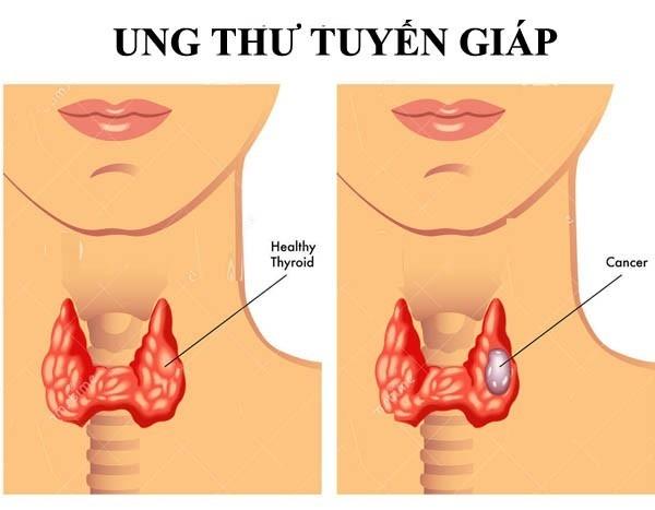 Bị ung thư tuyến giáp nên kiêng những món ăn nào?