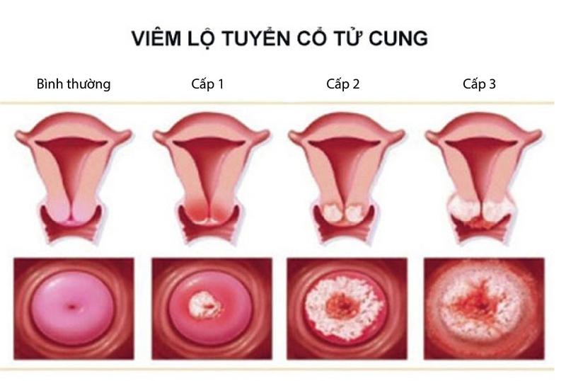 Viêm lộ tuyến độ 3 đặt thuốc có khỏi không và những cách điều trị 1