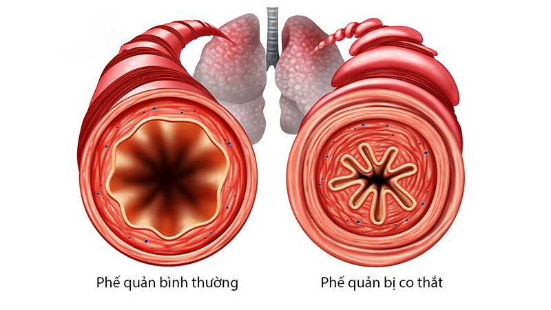 Co thắt phế quản dùng thuốc gì? Có khỏi dứt được không? 1