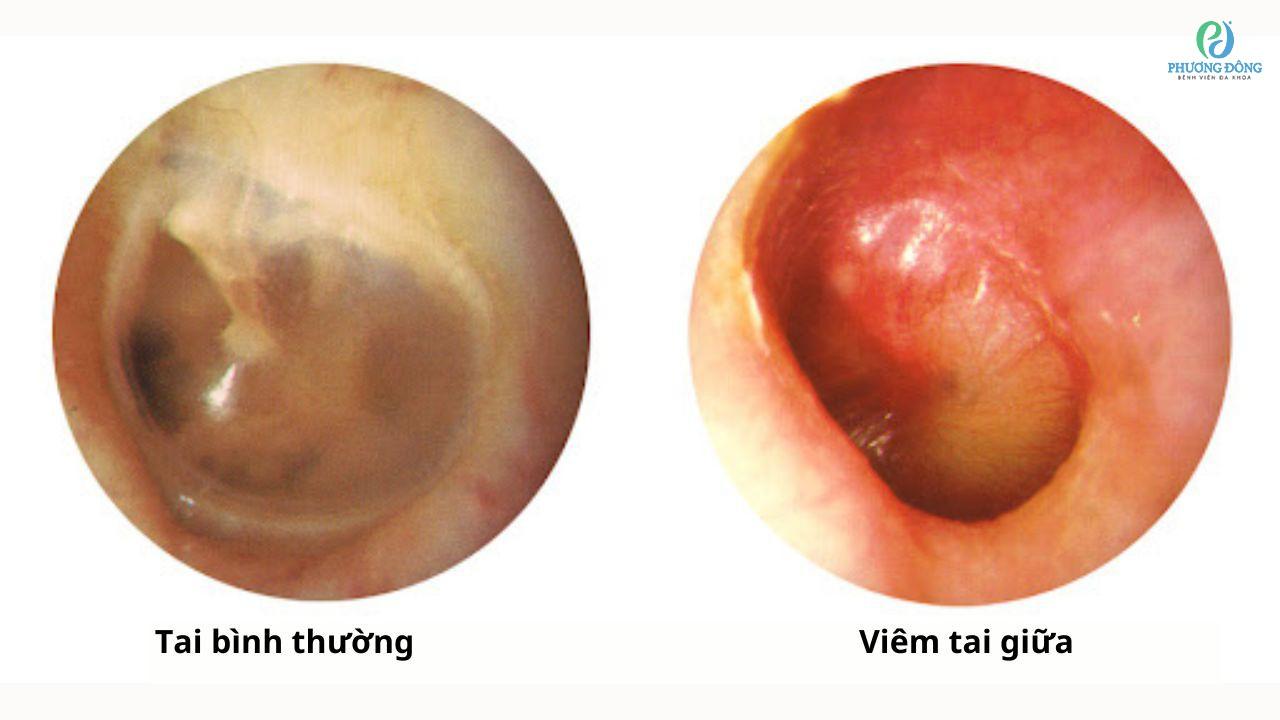 Bệnh nhân viêm tai giữa kiêng gì? 6 loại thực phẩm cần hạn chế