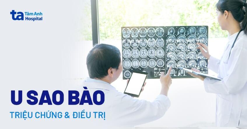 U sao bào (u não tế bào hình sao): Triệu chứng, nguyên nhân & điều trị