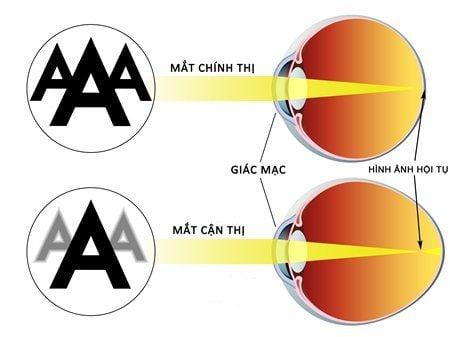 Các loại cận thị thường gặp và cách điều trị