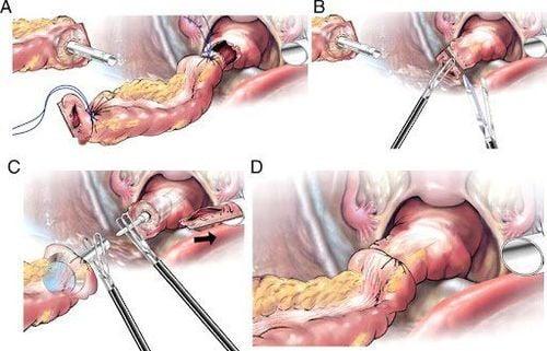 Phương pháp phẫu thuật ung thư đại tràng sigma tối ưu nhất