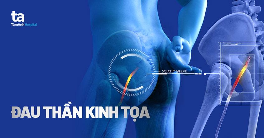 Đau thần kinh tọa: Nguyên nhân, triệu chứng và cách chẩn đoán