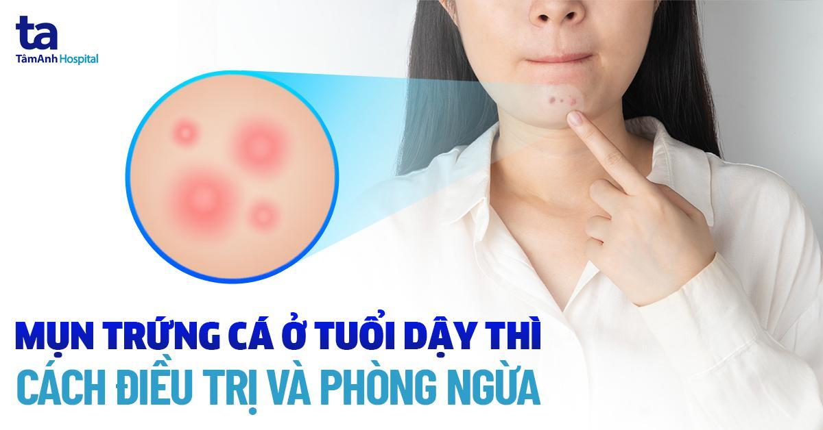 Mụn trứng cá ở tuổi dậy thì: Nguyên nhân, dấu hiệu, phòng ngừa