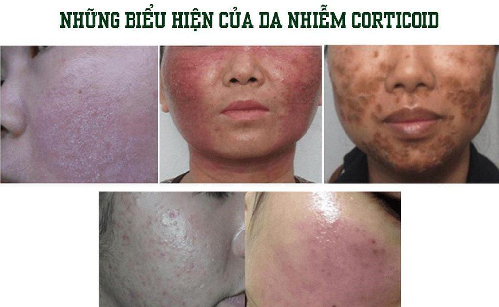 Biểu hiện của da bị nhiễm corticoid