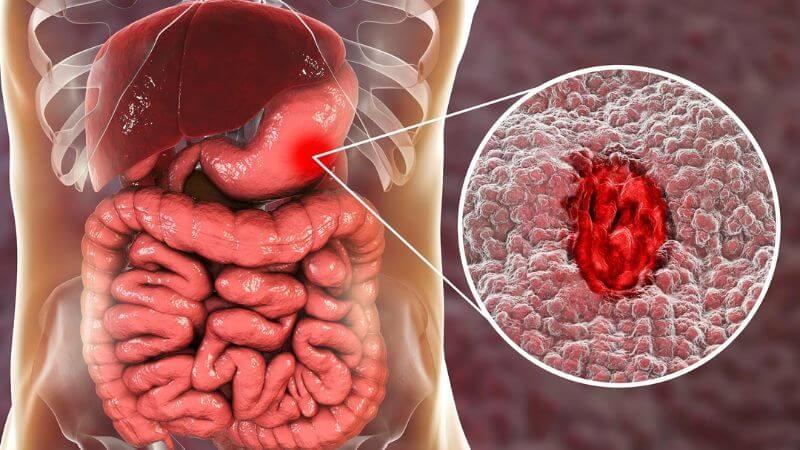 Đi cầu ra máu: Nguyên nhân, dấu hiệu, biến chứng và cách điều trị