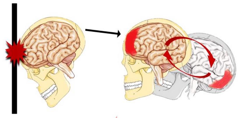 Đụng Dập Nhu Mô Não | Bài giảng CĐHA