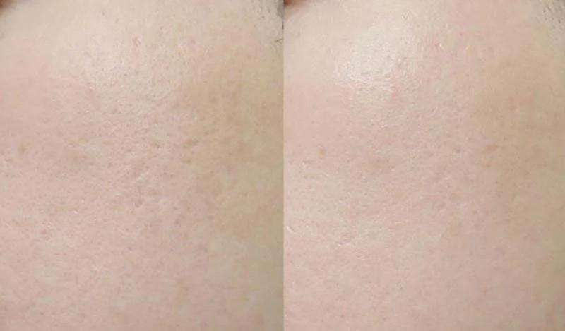 Review nước hoa hồng Pond's có tốt không? Có trị mụn không?