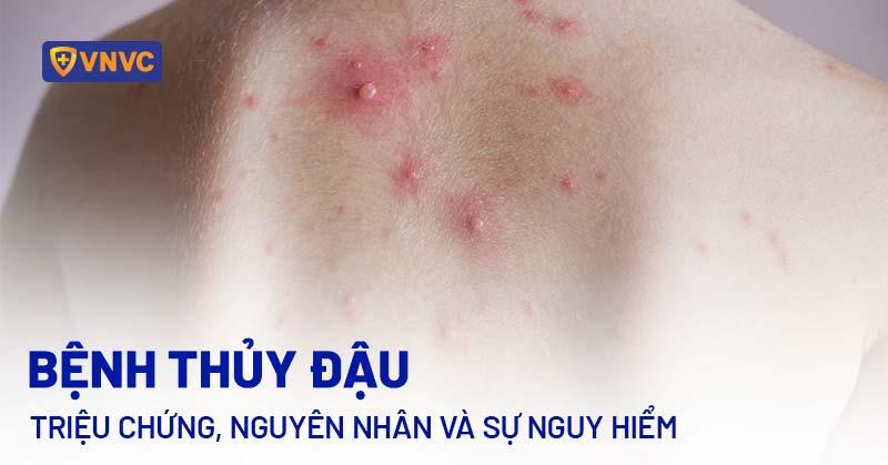 Bệnh thủy đậu: Triệu chứng, nguyên nhân và sự nguy hiểm