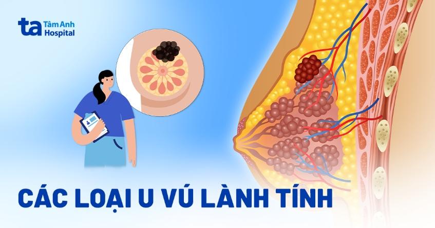 u vú lành tính