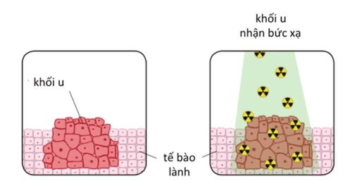 Xạ trị ung thư diễn ra như thế nào?