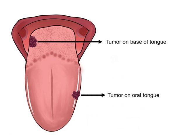 Vị trí xuất phát ung thư lưỡi