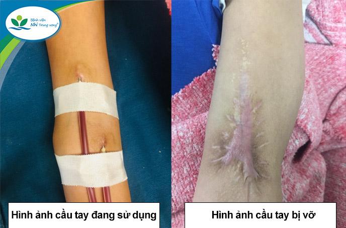Đặt Cầu Là Gì?