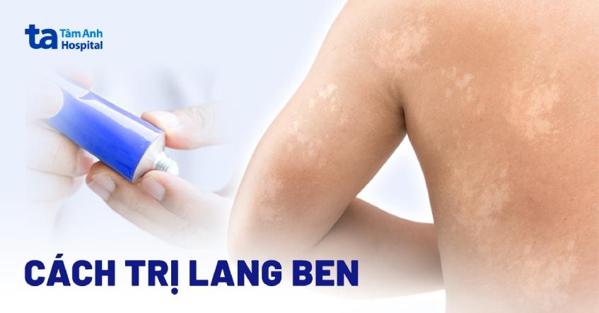 cách trị lang ben