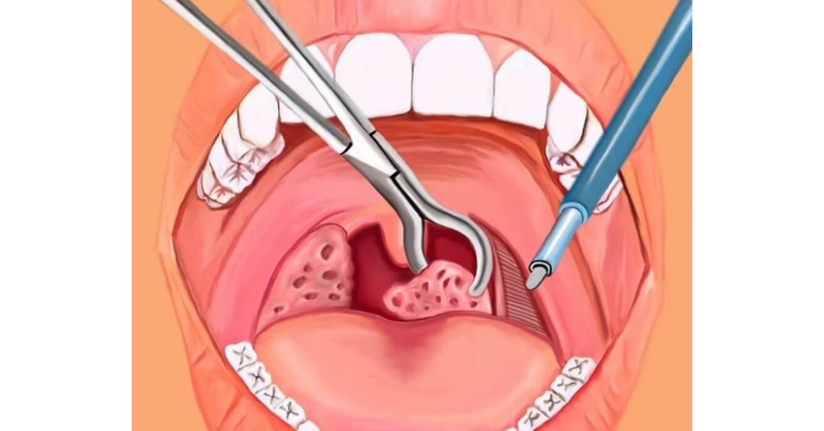 Phẫu thuật cắt bỏ mô Amidan bị ung thư - Ảnh: BV Ung bướu HN