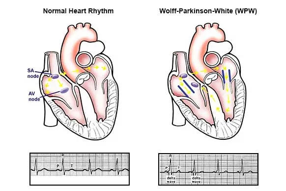 Hội chứng Wolff-Parkinson-White (WPW) là gì? Triệu chứng và nguyên nhân