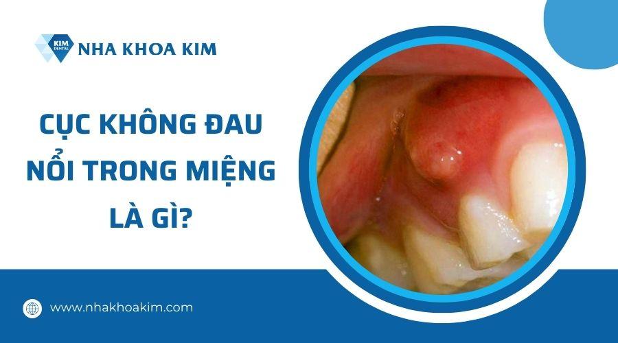 Cục không đau nổi trong miệng là gì?