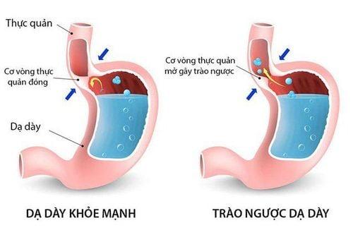 Khi mắc phải bệnh trào ngược dạ dày sẽ làm cho niêm mạc bị kích thích và hậu quả là sẽ khiến người bệnh bị tăng tiết nước bọt