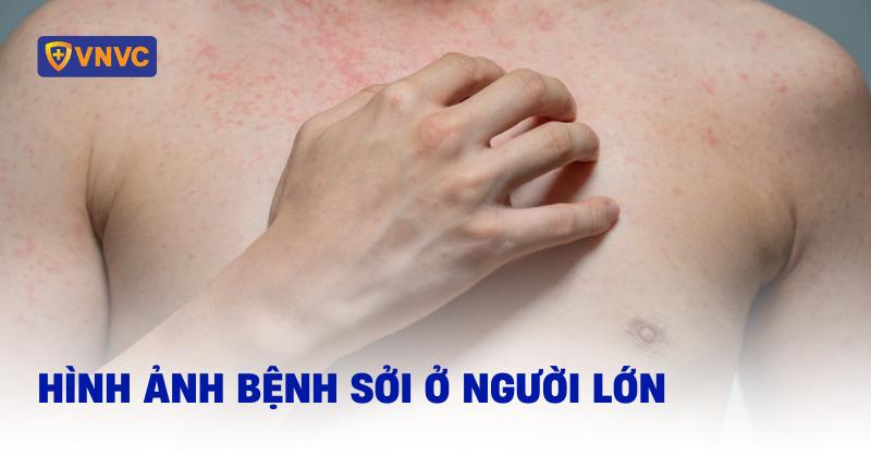 hình ảnh bệnh sởi ở người lớn