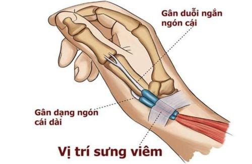 Vị trí đau của hội chứng de quervain