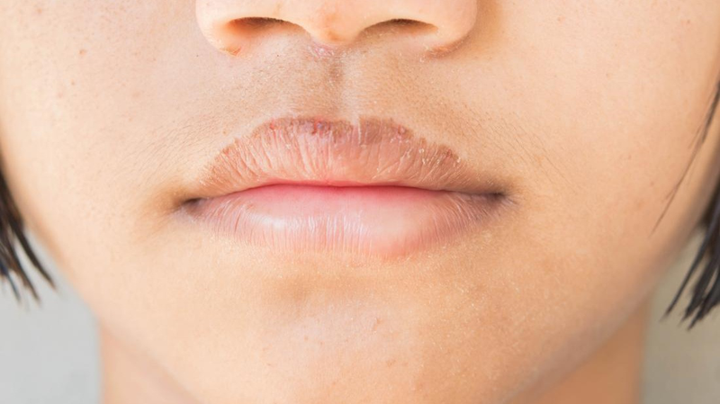 Môi có vết thâm đen cảnh báo bệnh gì? Làm sao để khắc phục môi thâm?