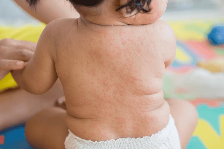 Giảm tiểu cầu gây ra các nốt bầm tím giống như phát ban ở trên da