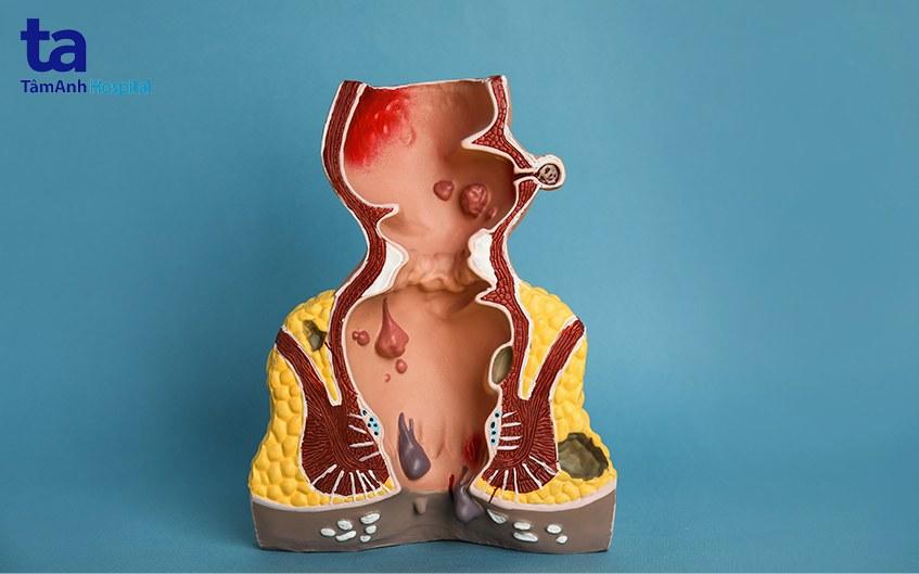 Bệnh trĩ sau sinh: Nguyên nhân, dấu hiệu, cách trị và phòng ngừa