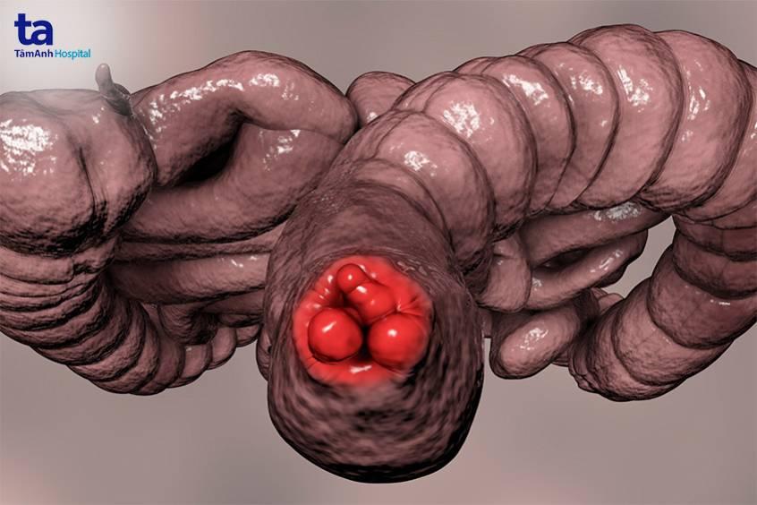 Bệnh trĩ huyết khối: Nguyên nhân, triệu chứng và cách điều trị