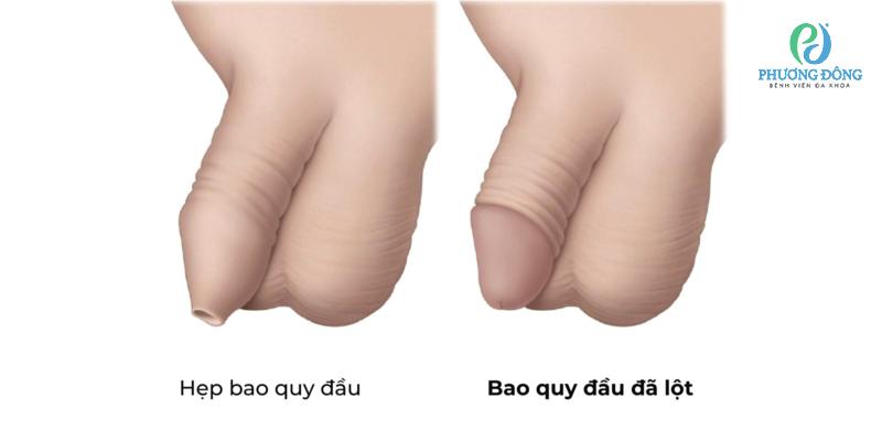 bao quy đầu