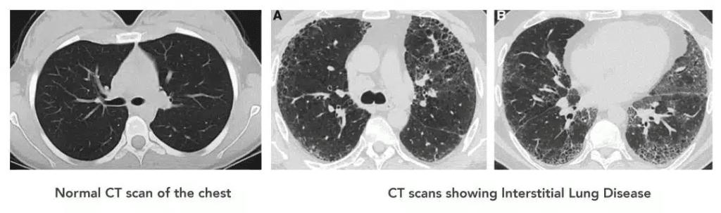 PHẢI LÀM GÌ KHI BỊ HO MÃN TÍNH HẬU COVID-19?