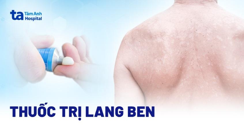 11 loại thuốc trị lang ben hiệu quả bác sĩ da liễu khuyên bôi đều