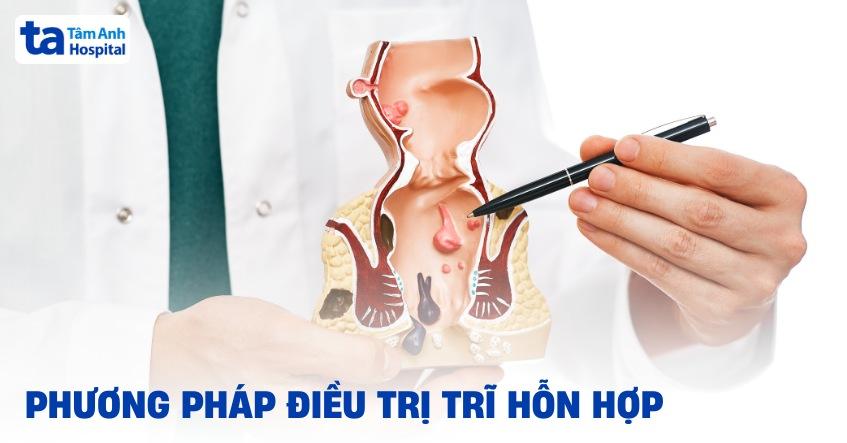 7 phương pháp điều trị trĩ hỗn hợp và ngăn ngừa bệnh tái phát