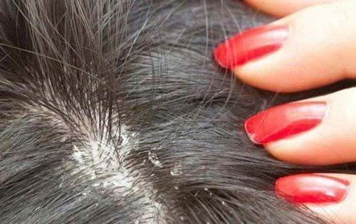 Nấm da đầu là nguyên nhân phổ biến nhất gây rụng tóc ở trẻ em