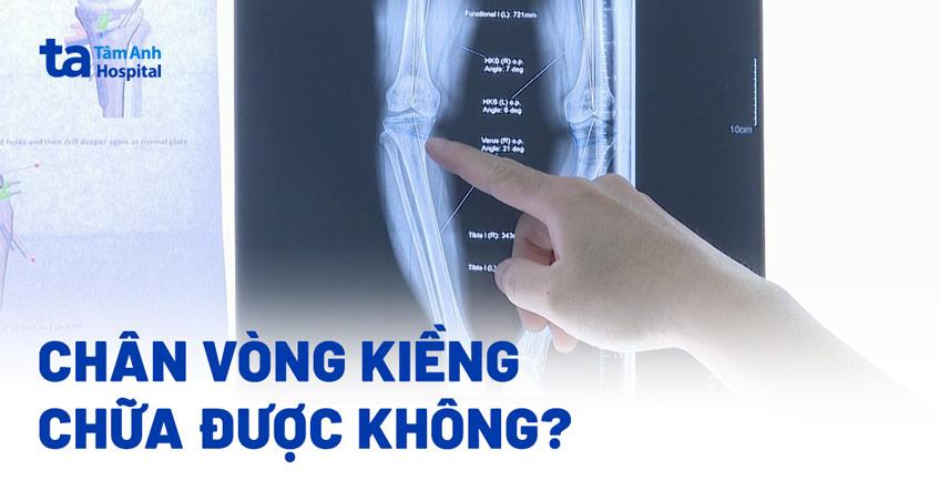 Chân vòng kiềng chữa được không