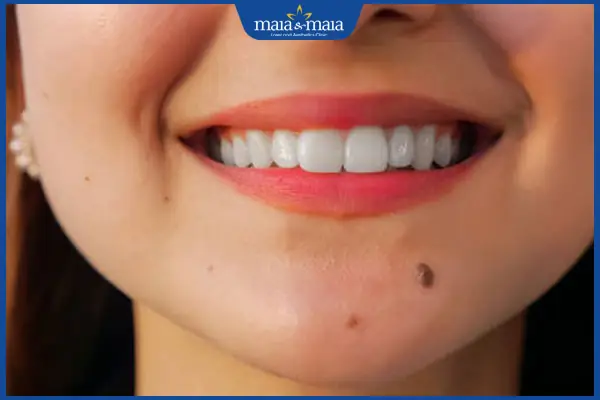 Nốt ruồi ở miệng là điềm tốt hay điềm dữ? Khi nào cần tẩy?