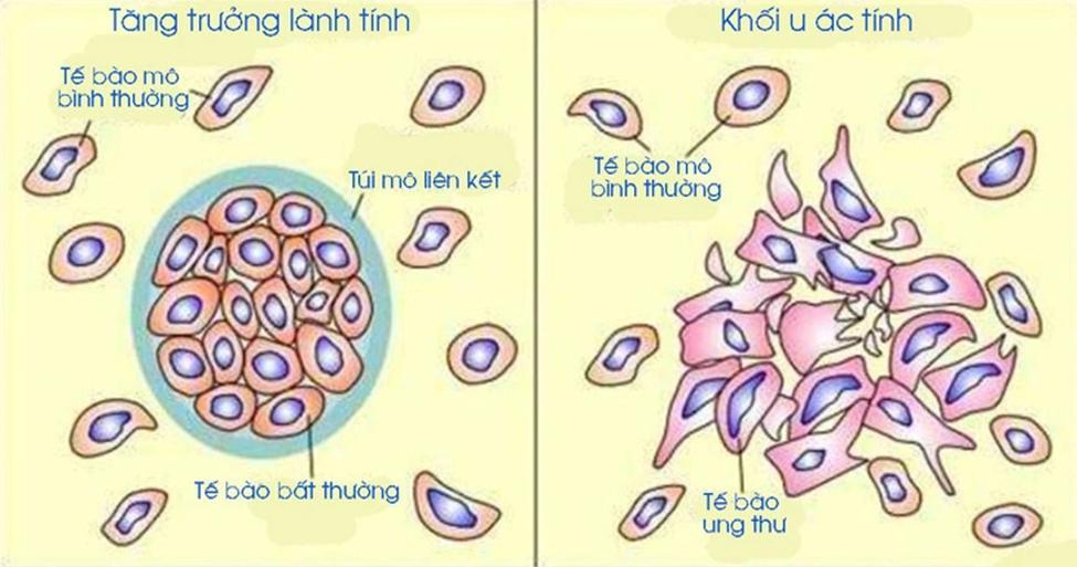 U ác tính và ung thư ác tính là gì? Hiểu sao cho đúng về thuật ngữ trong y khoa?
