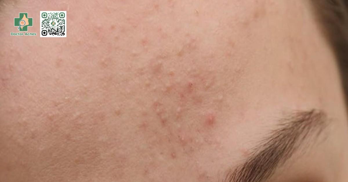 Top 6 kem trị mụn ẩn hiệu quả nhất hiện nay